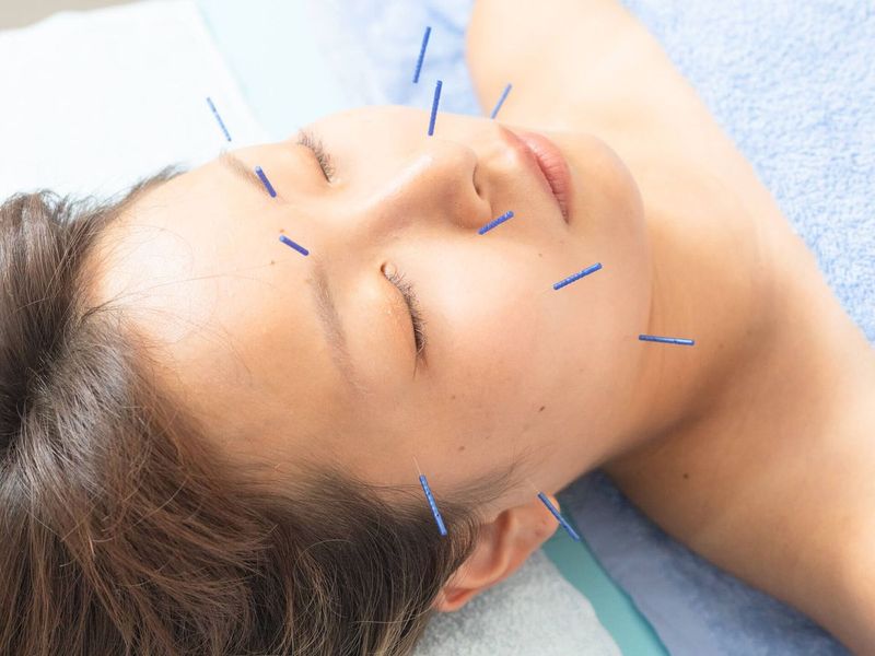 美容鍼の施術